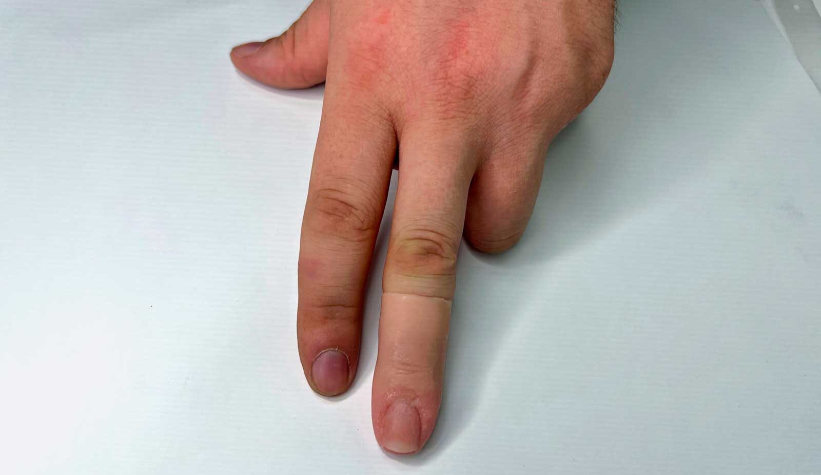 Индивидуальные протезы пальцев рук